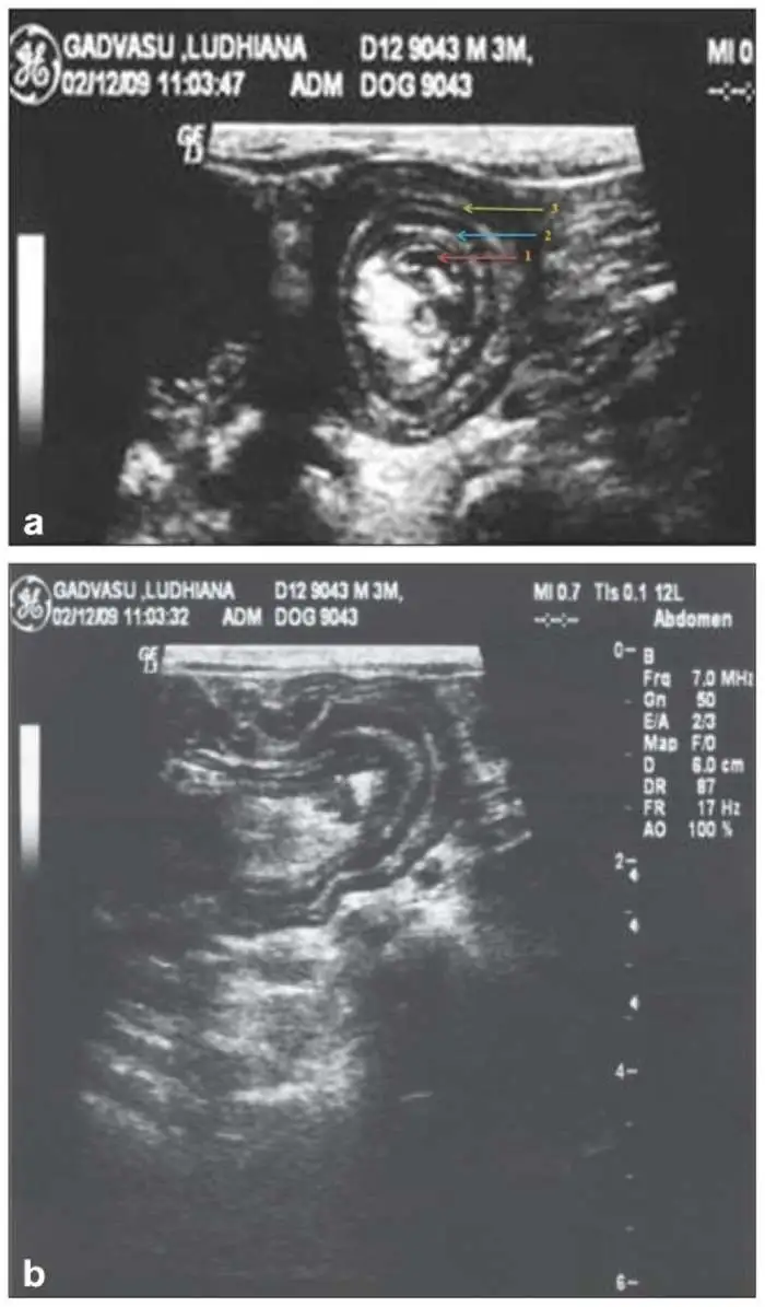 عکس پست جراحی انواژیناسیون، درهم‌روی روده‌ای (intussusception)2 